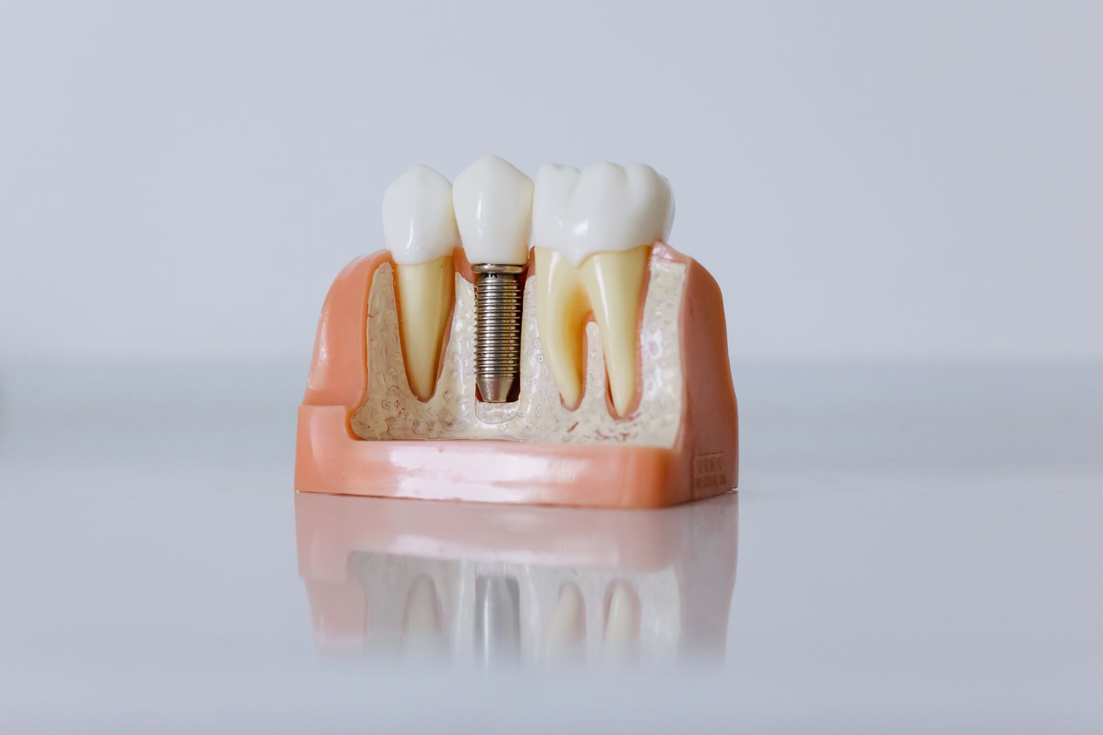 Dental implant model showing a titanium implant post between natural teeth